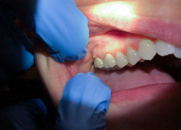 Best Emergency Tooth Extraction in Georgetown, IL